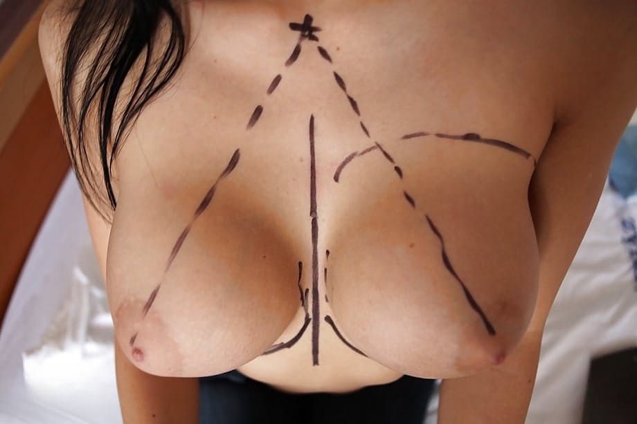 Aletta Ocean goes through successful plastic surgery operation